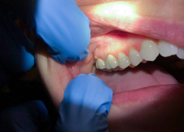 Best Emergency Dental Services for Seniors in West Reading, PA